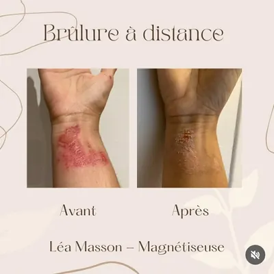 Brûlure au poignet, avant et après un soin à distance