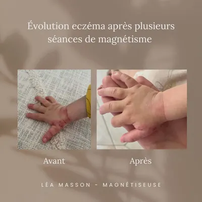 Eczéma sur la main d’un bébé, avant et après plusieurs séances