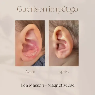 Impétigo sur l’oreille d’un enfant, avant et après