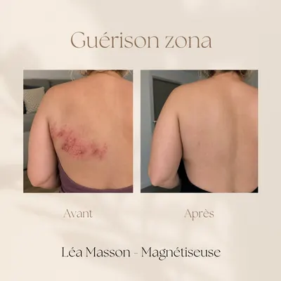 Illustration d’un zona dans le dos, avant et après un soin