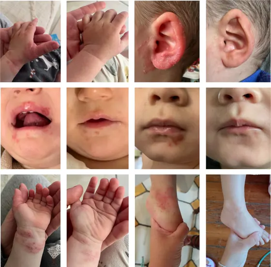 Douze photos avant et après : mains, oreilles, bouches et chevilles d’enfants
